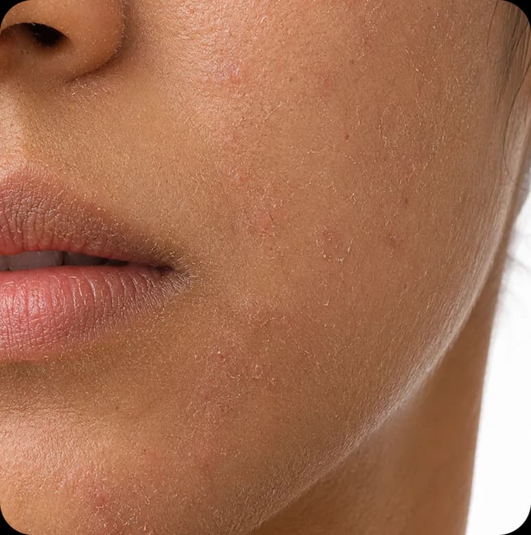 Close up of the lower half of a face, focused on the cheek