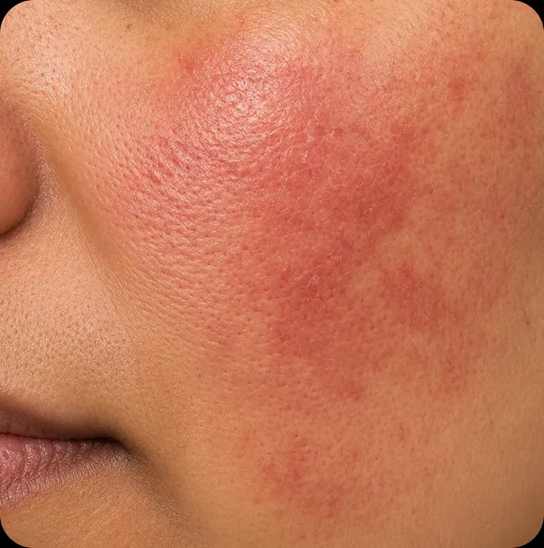 Close up of a cheek with pronounced redness and irritation